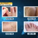 무좀원인 다양한 종류와 그에 따른 치료법까지 살펴보기 이미지