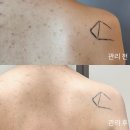 중앙동-1 | 안산 중앙동 보라뷰띠끄 등드름 관리 1회차 솔직 후기 !
