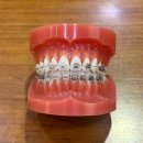 가지런한치과교정과치과의원 | [강남 스노우치과] 치아교정 후기