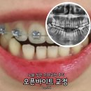 원바이트미 | [서울 노원] 성인 오픈바이트 개방교합 치아 교정 치료 내돈내산 솔직 찐후기