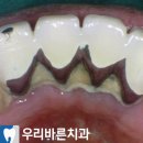 “제 소원은 평범한 식사를 하는 것 입니다.” 화곡동 치과 에서 시행한 전체 임플란트 수술 후기