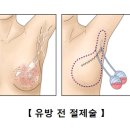 유방 이미지