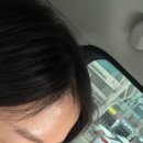 소이의원 이마 필러 후기 (통증,붓기)