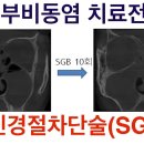 성상신경절차단술(SGB) 치료: 만성 부비동염 치료 효과 (알레르기비염,축농증,코골이,수면무호흡) 이미지