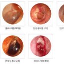 진주종 원인 합병증 이비인후과 진주종 이미지