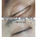 분당한의원에서 쥐젓&amp; 편평사마귀제거 후기
