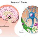 파킨슨병 한방치료 병행 효과입증 이미지