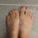문제성발톱 관리 시작 한달 후기