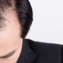 선헤어라인 이미지