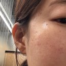 승리한의원 | 오래된 여드름패인흉터제거 새살침치료 7회차 치유과정 반월당 피부과 한의원에서