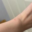 바른빛피부과의원 | 사마귀 냉동치료 1회차 후기