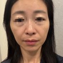 더웨이성형외과 지방이식 후기｜시술 전부터 6주차까지 변화 기록