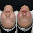 씨유진주평거우방점 | 진주 피부관리 ”소솜에스테틱“ 평거동 온다핏 리프팅 솔직 후기