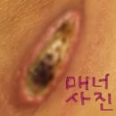 파란메딕스 | (혐주의ㅜㅜ)서울아산병원 조직검사 흉터치료 비포에프터/메피렉스/레이저치료/2017년~현재까지 사진