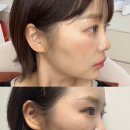 청담 피부과 루피엘의원 블룸업 쥬베룩볼륨 시술 앞볼 통증 내돈내산 후기