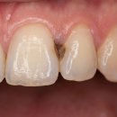 삼성이편한치과의원 | 야탑역보존치료치과 자연치아를 오래 사용하는 분당구 충치 보존치료 치과 이야기