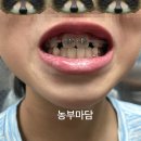 초등학생교정/운중동교정치과/서울다즐치과교정과의원