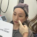 캐치웨이브 | 강남 신논현역 팔자주름, 얼굴볼륨에 좋은 힐로웨이브 전후 변화 후기