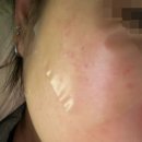 정영철피부과의원 | 정영철피부과의원 목동 잡티 레이저 시술 찐후기!