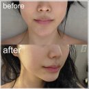 세븐메디컬 | 부천상동피부관리 휘게에스테틱 4주년 이벤트 허브이뮨케어 웨딩관리 후기