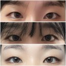 이마거상 실리프팅 후기 아이업눈꺼풀실리프팅 찐후기