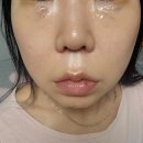아프지마약국 | 강남 비절개 눈밑지방재배치 잘하는곳 눈밑지방재배치 후기