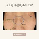농도318호선 | 수원 기미 피부과, 기미, 주근깨, 흑자 제거 후기