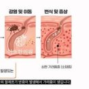 옴 진드기 증상 가려움증 알레르기 두드러기 치료법 이미지