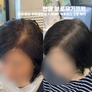 안양-안양-안양-515 | 안양 브로우기프트 - 여자 탈모 두피생장술 + SMP 두피문신 2회 후기