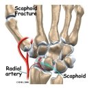 손목 주상골 골절 (Scaphoid Fracture) 이미지