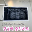 강남역 충치치료잘하고 과잉진료없는 강남역치과추천 인레이한 후기