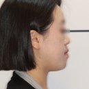 비수술 주걱턱 교정 후기, 교정기 끼기만 하면 되네?