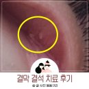 코지아지 | 결막 결석 치료 눈 히알산 후루손 점안액 처방 후기