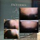 김모진헤어미가 | 대전 도안동 페이스디자인 내돈내산 헤어라인커버 2차 리얼후기