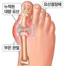 통풍 증상에는 어떠한 증상들이 있는지 이미지