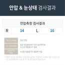 수오래 | [렌즈삽입술] 렌즈삽입술 후기 - ICL렌즈삽입술, 내피세포 수, 오래된 후기