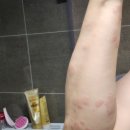 후기] 갑자기 지속적으로 발생하는 알레르기 검사...검사 실비보험 가능 여부/ 서면 에스피부과의원