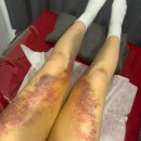 지방 | 신사 허벅지 지방흡입주사 3~4주차 지방추출 후기