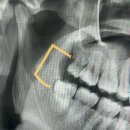 라이프치과의원 | 왓츠인마이라이프 5주차 사랑니 2개 한번에 발치하기(ft. 톡톡사랑니치과의원)
