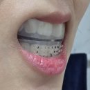 덴탈스페이스 | 가정용 치아교정기 자가치아교정기 덴탈스 인비저 3단계 사용후기