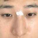 신사동-10 | 봉합흉터 패인흉터 신사동 새살침 후기 10탄(새살침1차)