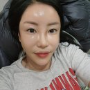 텐 프로 | 동작구 피부과 고주파리프팅 텐써마 300샷 후기 │ 2주 경과 텐써마 효과 솔직 변화