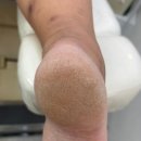 문제성 손,발 오감네일