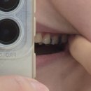 강북바를정치과의원 | 1. 성인 비수술 턱교정 교정일기, 근데 이제 충치치료를 곁들인