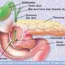 요로결석(urinary calculus) VS 담석(gallstone) 이미지