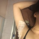 리즈힐의원 | 내돈내산 겨드랑이 다한증 보톡스 시술기 : 힐리브의원