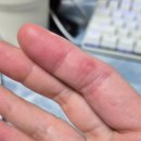 수원-1914 | 수원 서울 손 유리 조각 제거 수술 후기 | 적합한 병원 찾기 , 셀프 소독 재료 추천