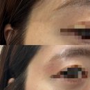 노원한의원 | 노원한의원추천 패인흉터제거 새살침 후기(+부작용, 경과 등)