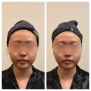 브이(V) | 서면 윤곽관리 효과 대박! 카리언뷰티클리닉 브이로 윤곽 관리 1회 후기