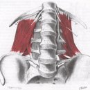 * 근막통 증후군 (요방형근) 이미지